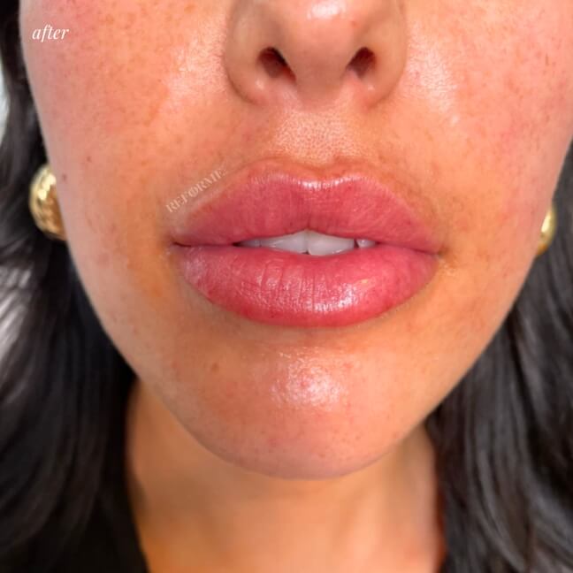 lip fillers toronto mississauga