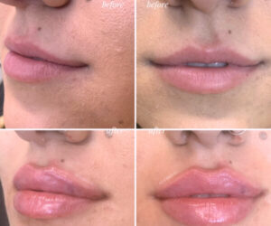 lip injections gta