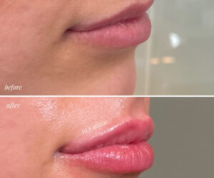 lip injections in gta