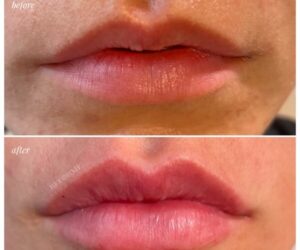 lip injections near me