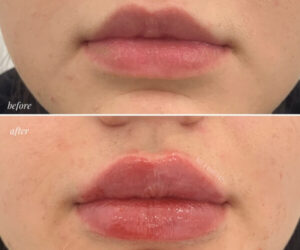 natural lip fillers