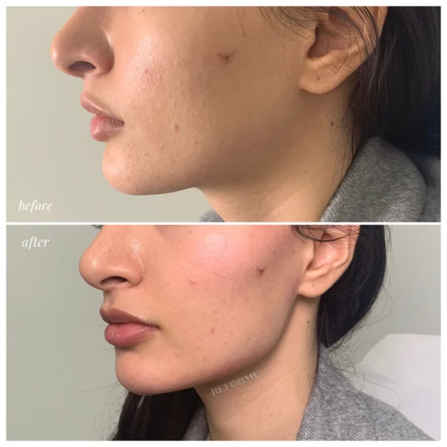 non surgical face lift gta
