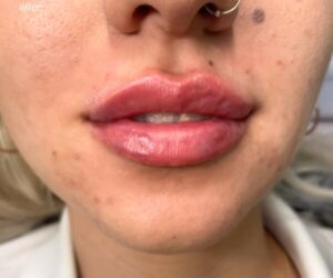 plump lip fillers gta