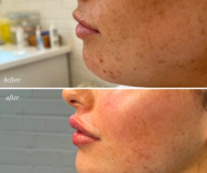 professional lip plumping