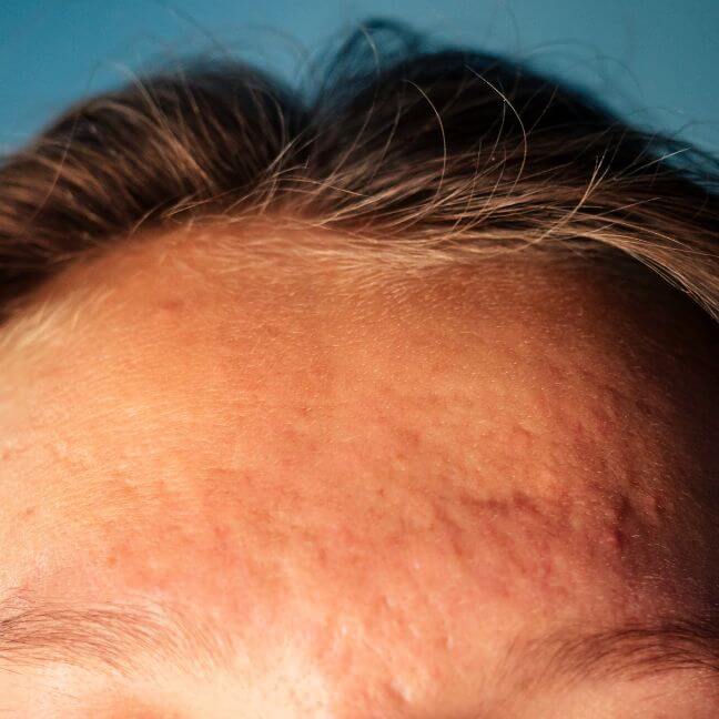 what causes acne scars