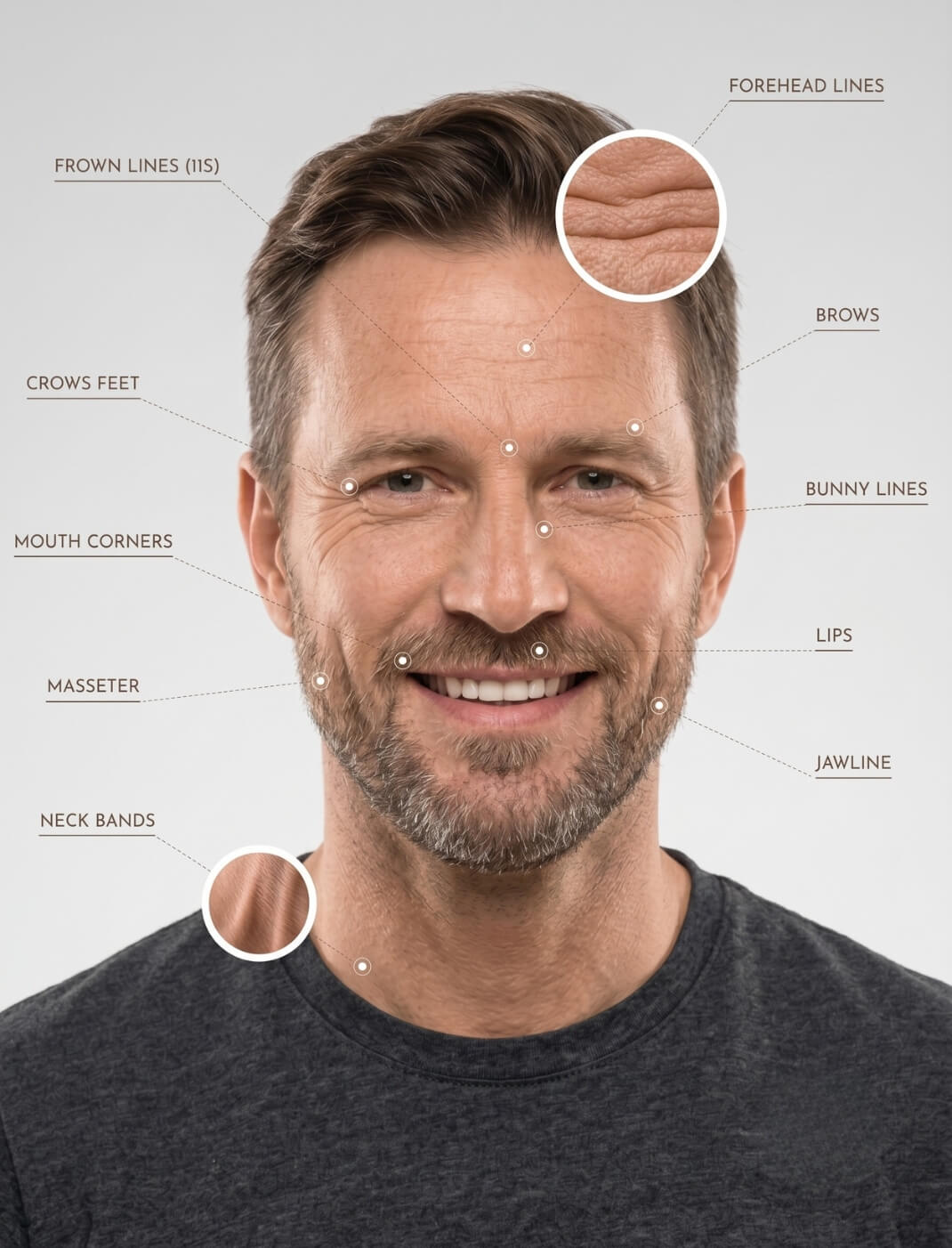 how many botox units do men need